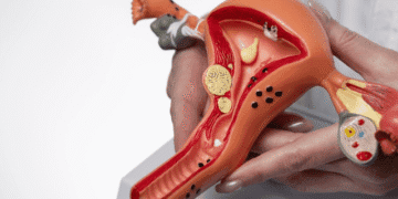 Endometriose: saiba reconhecer os alertas e sintomas