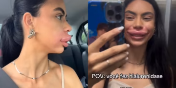 Miss Pomerode tem inchaço extremo nos lábios após procedimento estético e viraliza: ‘Usada de exemplo’