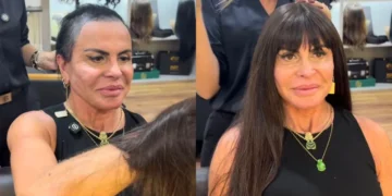 Gretchen aparece sem prótese capilar e detalha tratamento contra alopecia